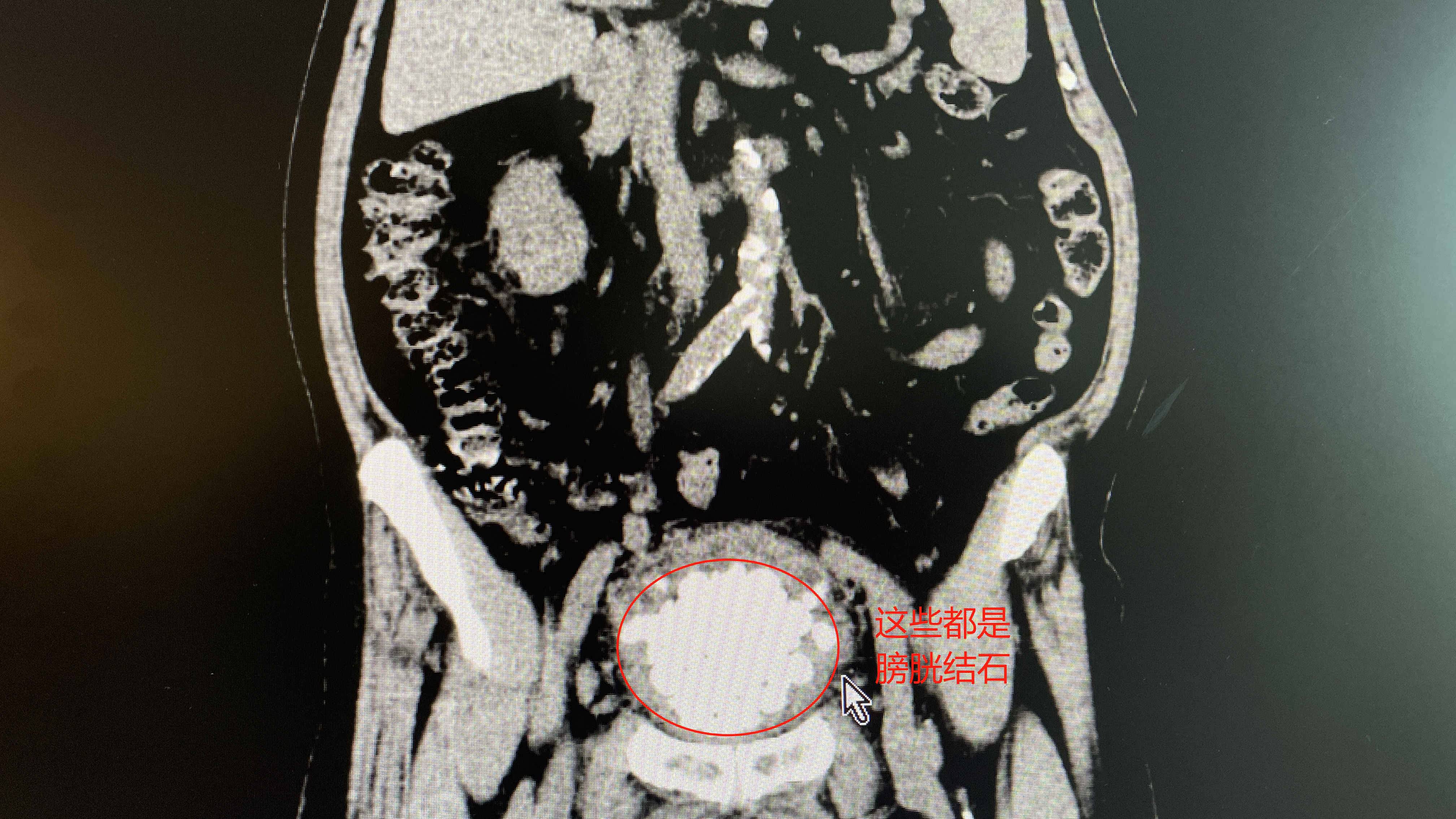 【番禺融媒】惊！八旬老翁膀胱藏石数百颗，广东祈福医院妙手取石