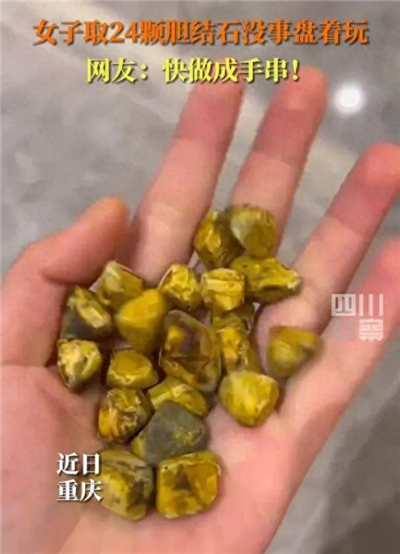 女生取24颗胆结石没事盘着玩，网友提议做手串