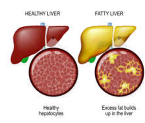 脂肪肝年轻化，瘦人都不可避免！专家提醒这样做