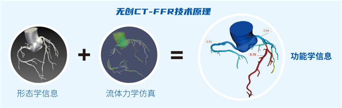 厉害了！CT-FFR技术，“算”出血管造影“心声”